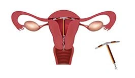 IUD برای جلوگیری از بارداری
