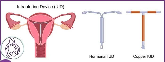 جلوگیری از بارداری با IUD